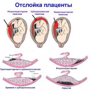 При прикреплении плаценты по передней стенке боль выражена спереди, в некоторых случаях прощупывается напряженную и резко болезненную припухлость