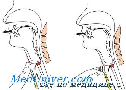 Второй этап формирование псевдо голосовой щели и вызывание пищеводного голоса