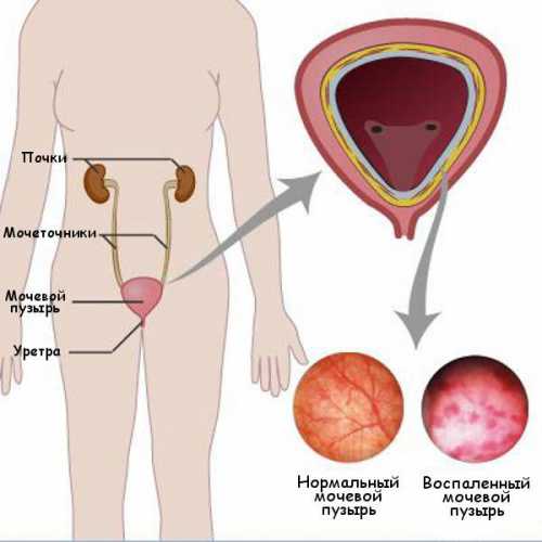 Как снять воспаление мочевого пузыря