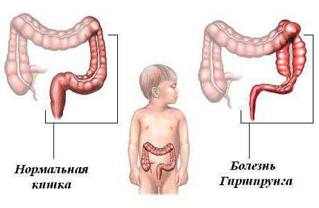 Слабительные средства, клизмы не приносят результата