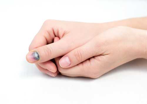 Что делать при ушибе ногтя, что поможет и что