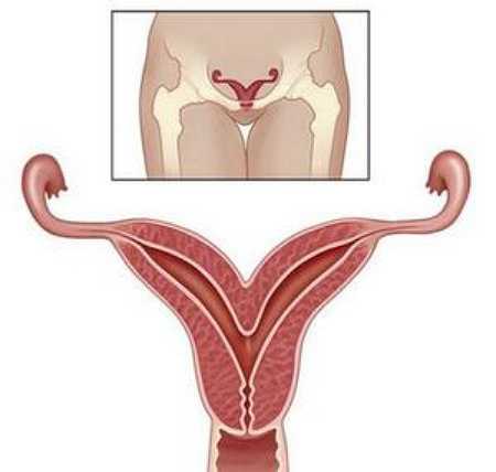 Седловидная матка и беременность