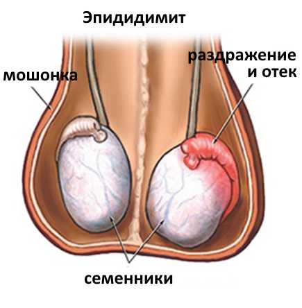 Инфекционные поражения яичек